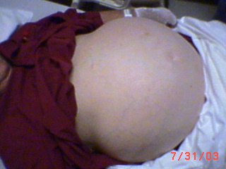 ascites1.jpeg