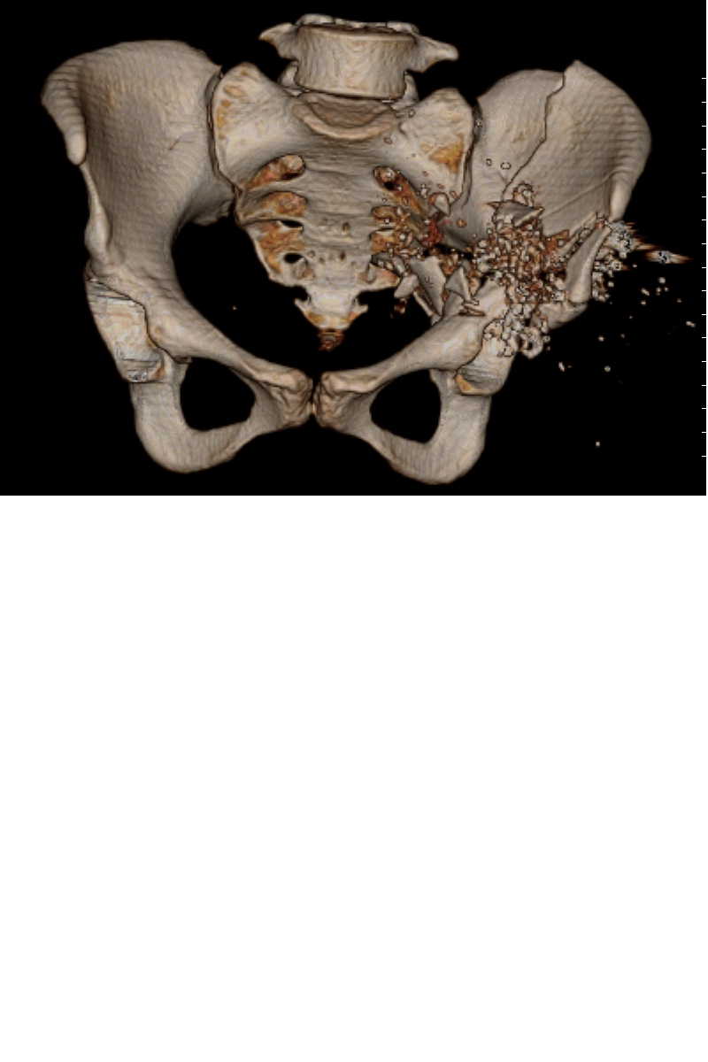 gswpelvis.jpg
