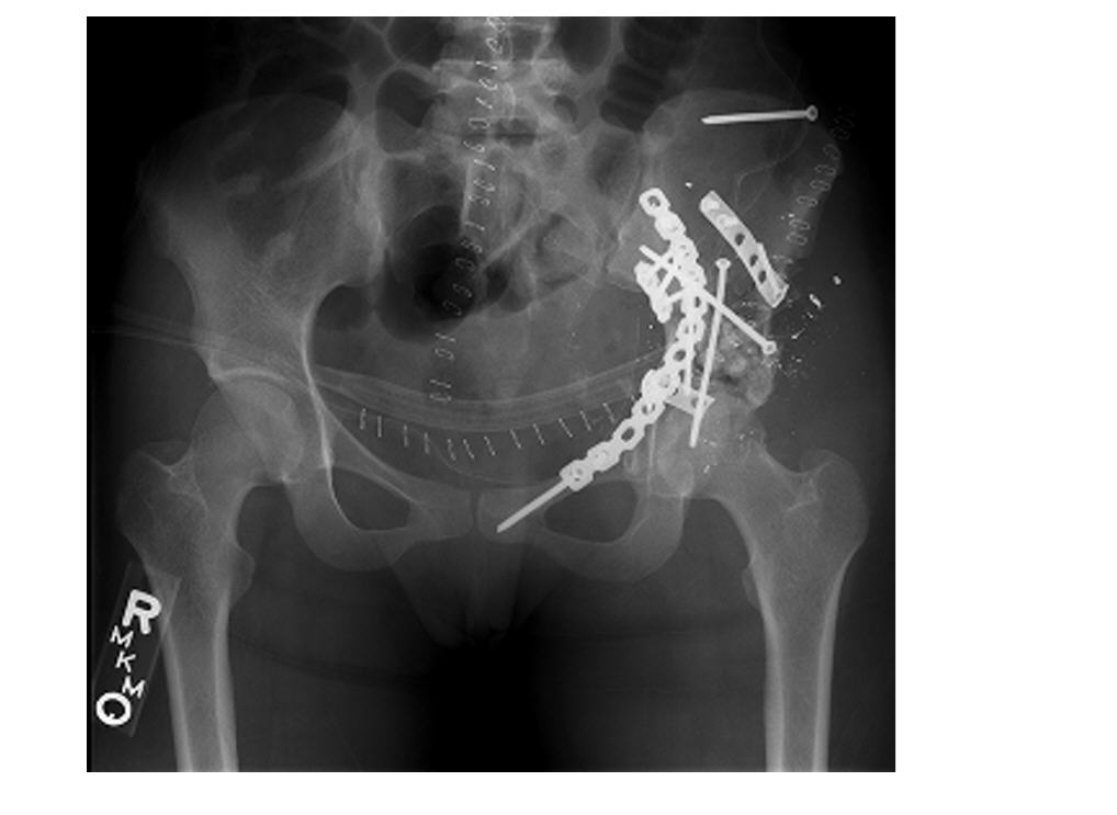 pelvis_repair.jpg